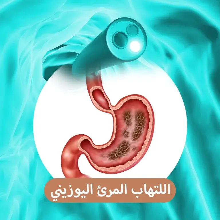 حساسية المريء: عندما يواجه جهازك الهضمي "حساسية الطعام"