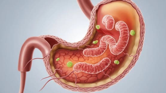 جرثومة المعدة (H. Pylori): كل ما تحتاج معرفته عن "العدو الخفي"