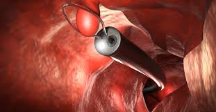 خزعات المناظير (Biopsies): لماذا يأخذ الطبيب عينة من جدار المعدة أو القولون؟ وهل هذا يدعو للقلق؟