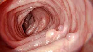 لحميات القولون (Colon Polyps): كيف يكتشفها المنظار ويستأصلها لمنع الأورام؟